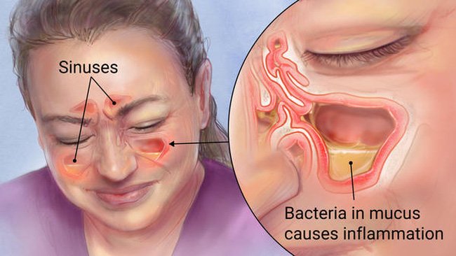 [General] What are the types of sinusitis? Picture 4